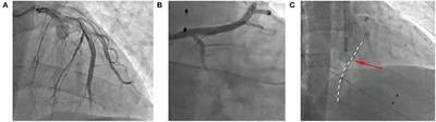 Differential Diagnosis of Fulminant Myocarditis and Acute Coronary Syndromes in the Case of Failure of Coronary Angiography: A Case Report